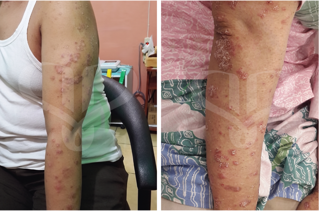 Kondisi awal pasien psoriasis vulgaris